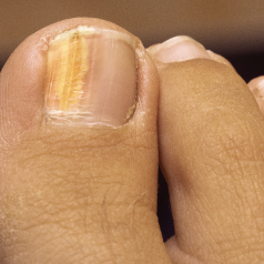 Onychomycosis