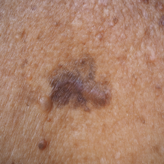 Pigmented Lesions