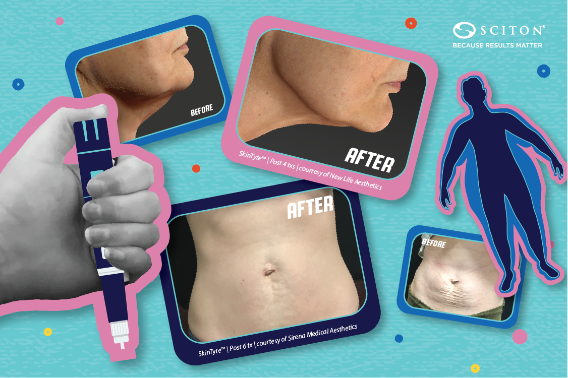 laseraway glp-1 What Providers Are Noticing About GLP-1s And Skin & How Laser Treatments  Can Help