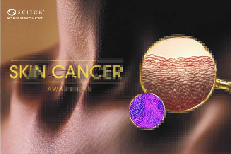 Skin Cancer Awareness